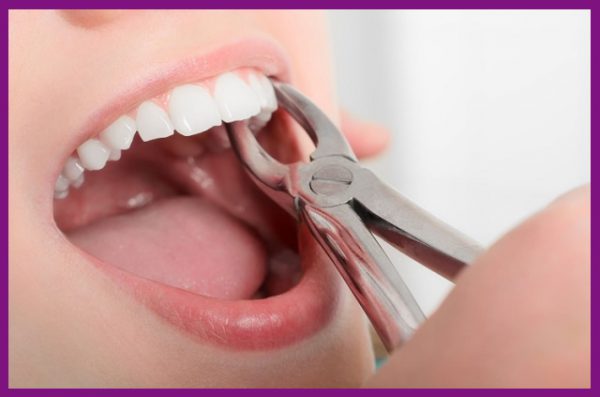 khi răng số 7 bị nhổ bỏ thì nên chọn phục hồi ngay bằng implant để bảo tồn răng