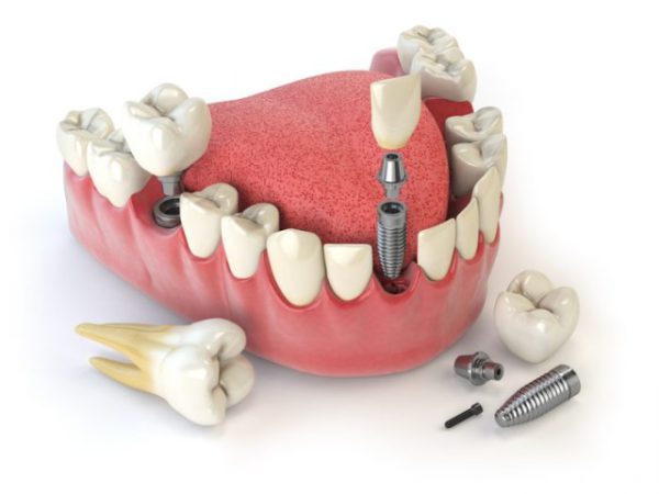 Giải pháp trồng răng số 7 nào tốt và hiệu quả nhất với người bệnh mất răng?
