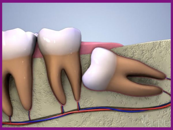 răng số 8 là răng thường mọc ngần, mọc lệch do thiếu chỗ