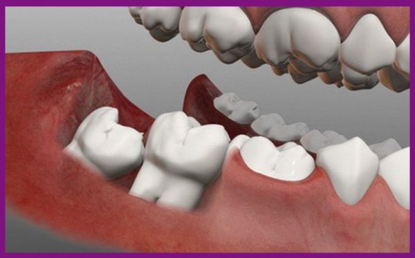 răng số 8 tiềm ẩn những biến chứng gây nguy hiểm đến toàn hàm