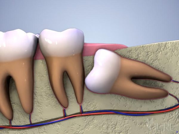 Trồng răng số 8 implant sau khi nhổ nên chọn biện pháp nào?