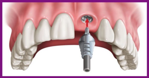 trồng răng implant mang lại những lợi ích vượt trội cho người mất răng lâu năm