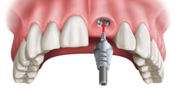 Muốn trồng răng thật thì nên chọn kỹ thuật nào là tốt nhất?