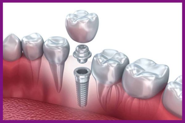 trồng răng implant là phương pháp khắc phục tình trạng tiêu xương hàm hiệu quả