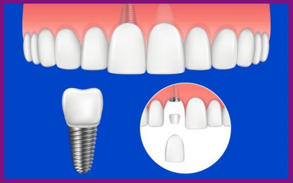 cấy ghép implant - biện pháp thẩm mỹ răng mang lại hiệu quả toàn diện và tối ưu