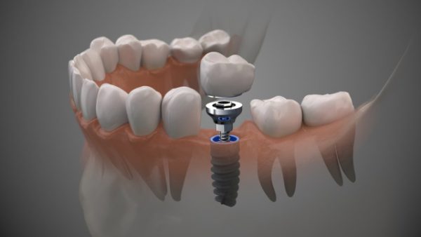 Bật mí các thương hiệu trụ implant mỹ tốt nhất thị trường hiện nay