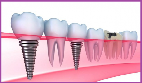 trụ răng implant hàn quốc c