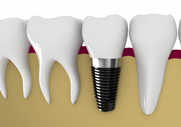 trụ răng implant hàn quốc