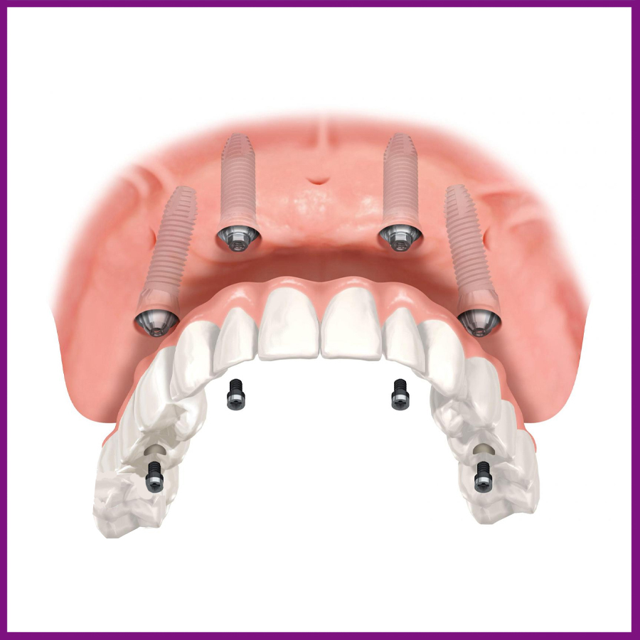 phục hình tạm trên răng implant
