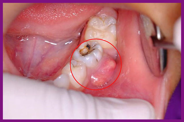 Điều trị tủy răng là gì?