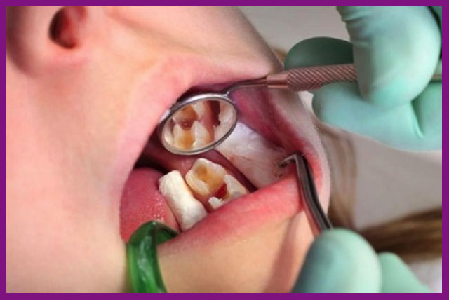 Những trường hợp điều trị tủy răng