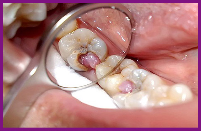 Răng sâu ảnh hưởng đến tủy răng 