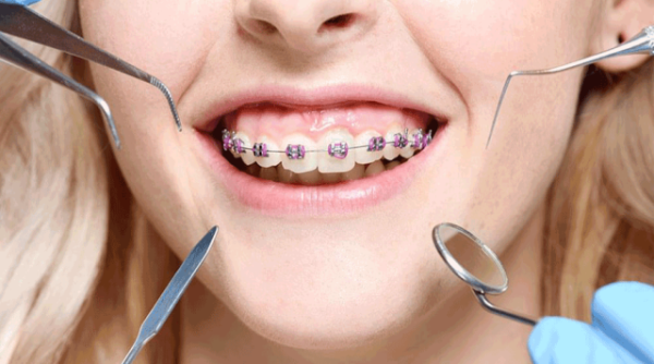 Tìm hiểu tổng quát về các giai đoạn niềng răng