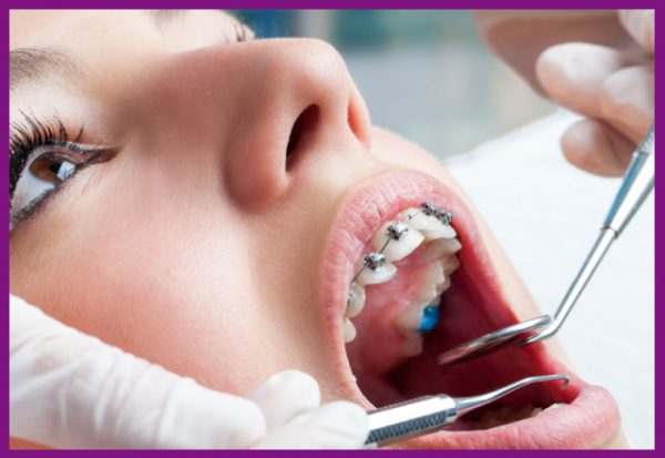 giai đoạn siết răng cũng có thể gây đau