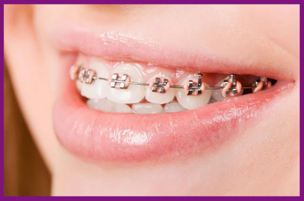 cần bảo vệ sức khỏe răng miệng sau niềng răng