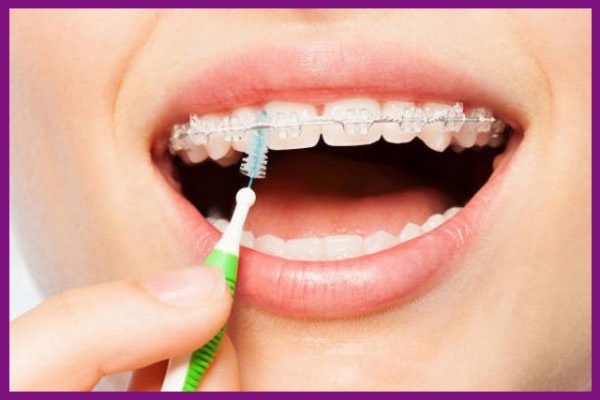 vệ sinh răng miệng thật kỹ sau khi ăn