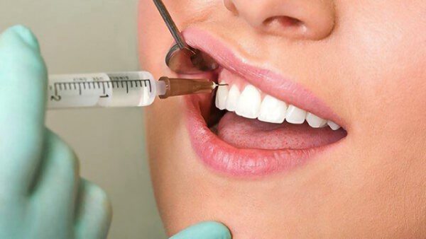 cách chữa viêm tủy răng