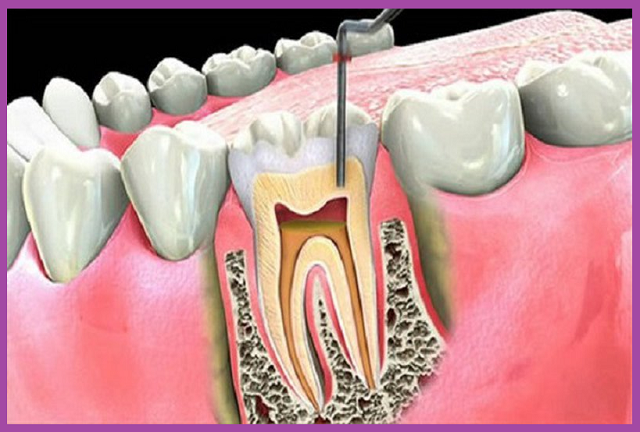 cách chữa viêm tủy răng hiệu quả