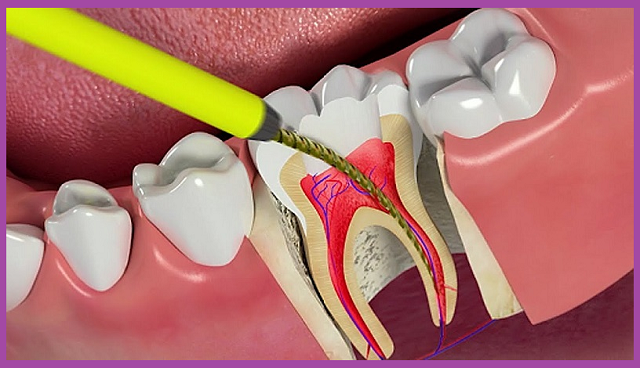 cách chữa viêm tủy răng nhanh chóng