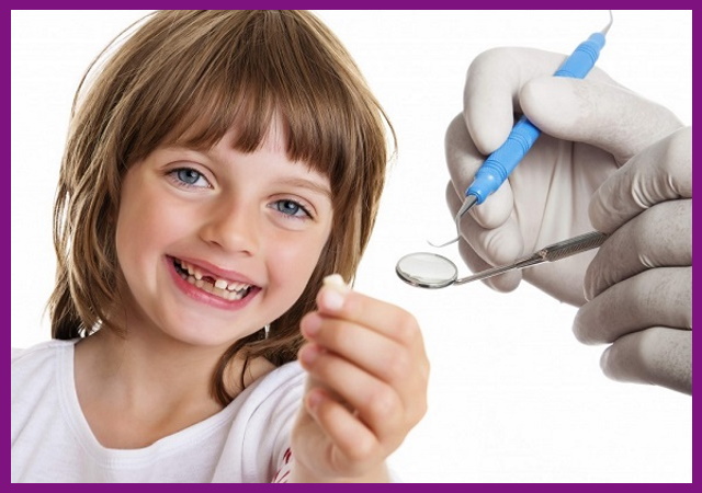 nhổ răng cũng là cách điều trị viêm tủy răng ở trẻ em