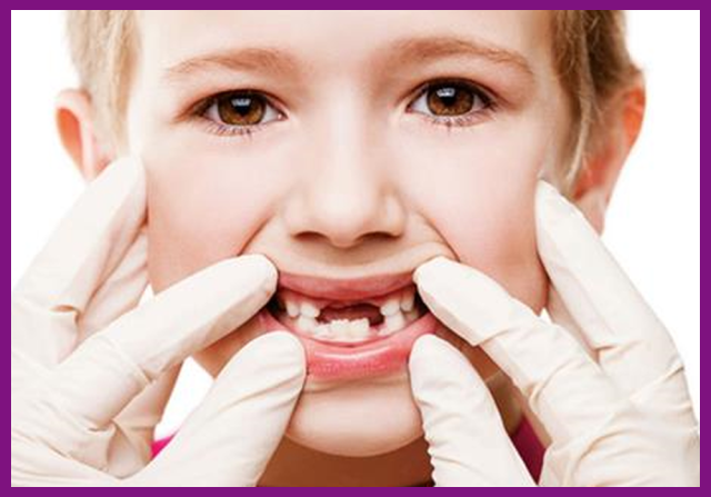 viêm tủy răng ở trẻ em thường là do sâu răng nặng gây ra