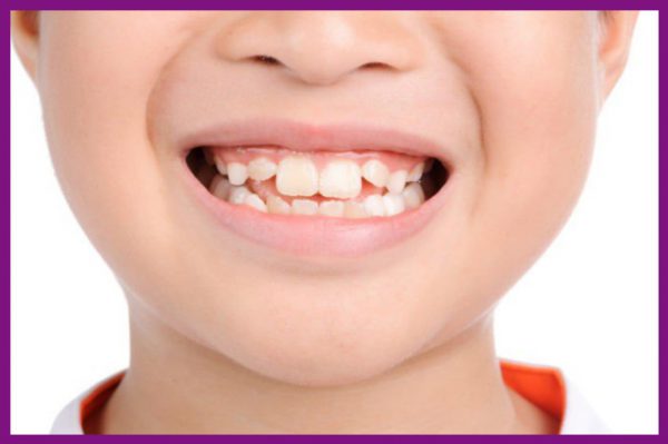 niềng răng là giải pháp hữu hiệu trong trường hợp răng mọc lệch, lộn xộn