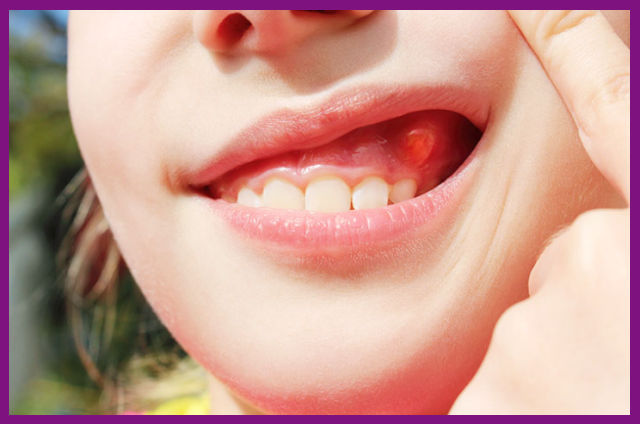 viêm lợi là bệnh lý do trẻ vệ sinh răng miệng không kỹ