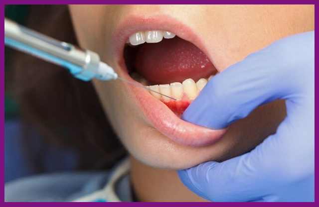 chi phí chữa tủy răng bao nhiêu tiền phụ thuộc vào vị trí răng và mức độ viêm tủy