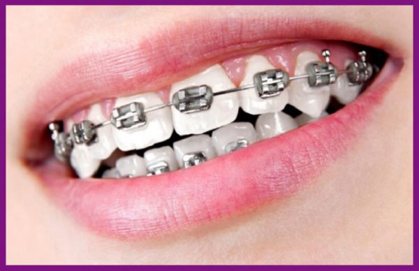 niềng răng cho hiệu quả chỉnh nha cao, chi phí hợp lý