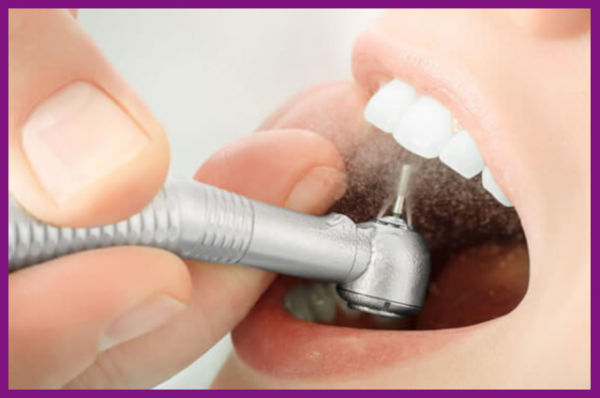 mài răng khiến răng dễ bị kích thích và nhạy cảm hơn