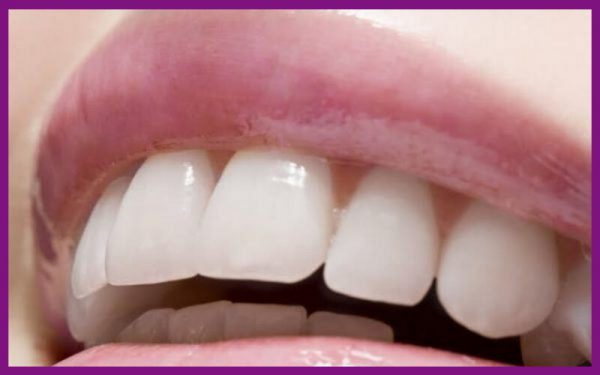 răng hô gây ảnh hưởng đến thẩm mỹ, khiến người bệnh tự tin khi giao tiếp