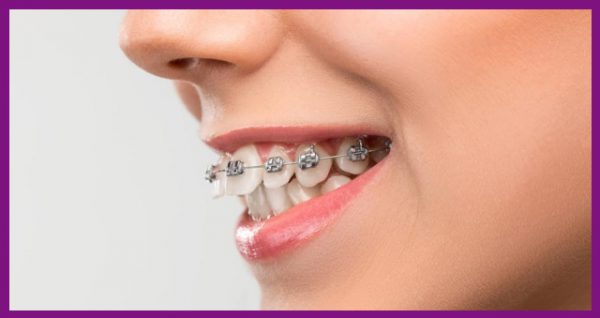 niềng răng là phương pháp tối ưu để chữa răng hô