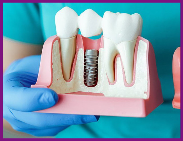kỹ thuật trồng răng implant tại hanoi sydney đạt chuẩn an toàn cao, hiệu quả mang lại vượt trội