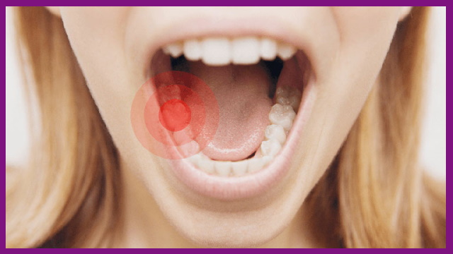 viêm tủy răng gây đau nhức, khó chịu, cần phải sử dụng kim bơm rửa để loại trừ phần tủy bị tổn thương