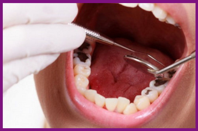 cần tìm nha khoa chữa trị tủy răng uy tín