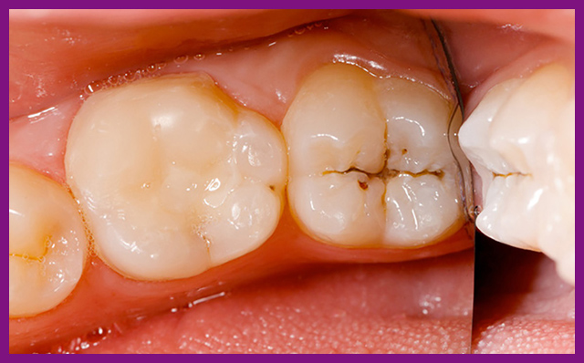 Dấu hiệu viêm tủy răng phục hồi