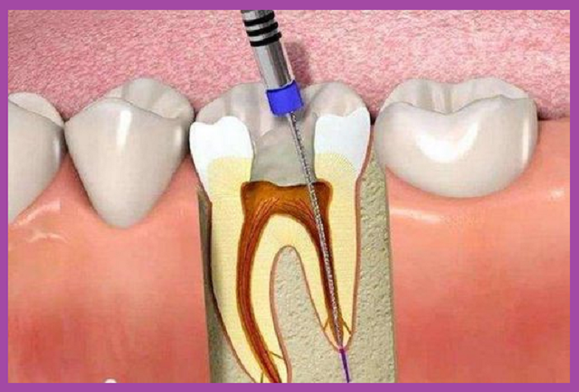dịch vụ trám răng lấy tủy an toàn