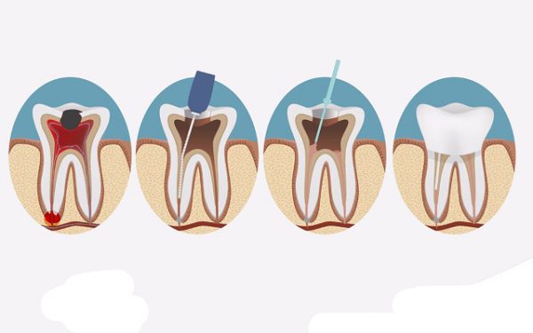 điều trị nội nha