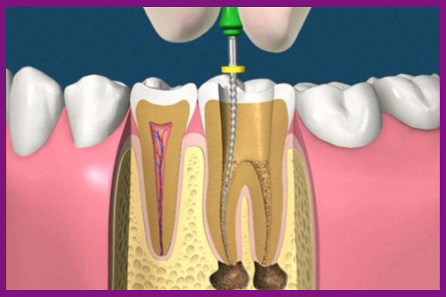 chữa tủy răng nên ứng dụng các thiết bị nha khoa hiện đại