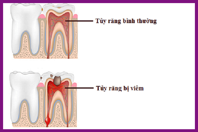 tủy răng bị viêm là tình trạng bệnh lý về răng miệng khá phổ biến hiện nay