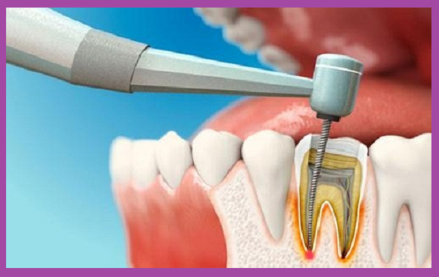 điều trị tủy răng hàm đảm bảo