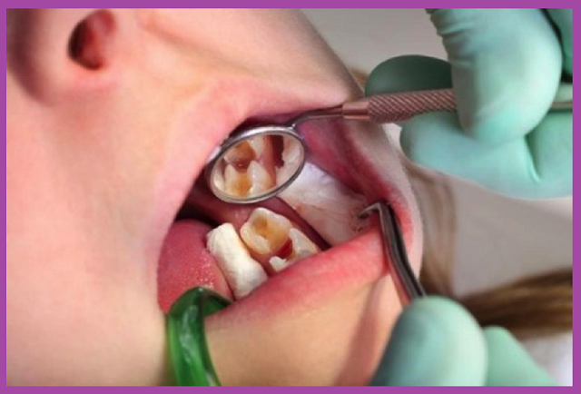 dịch vụ điều trị tủy răng hàm