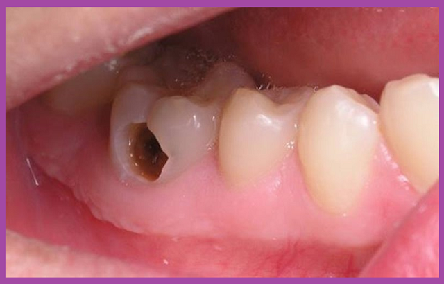 điều trị tủy răng hàm giá tốt