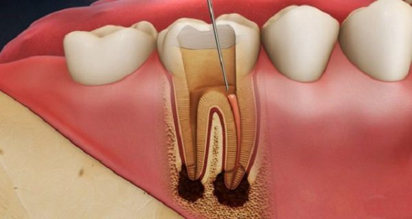 điều trị viêm tủy răng