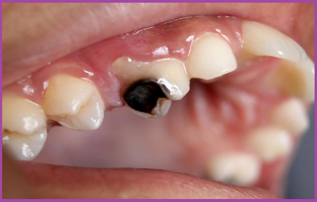 điều trị viêm tủy răng hiệu quả