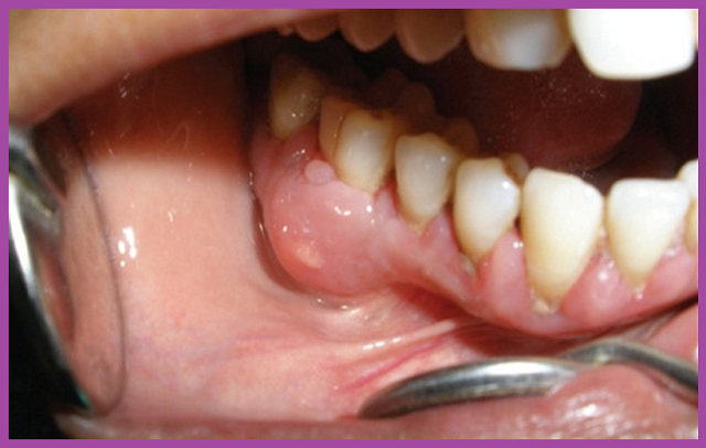 dịch vụ điều trị viêm tủy răng