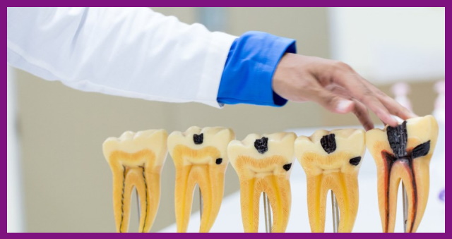 thời gian chữa trị tủy răng tốt nhất là ở giai đoạn tiền tủy răng