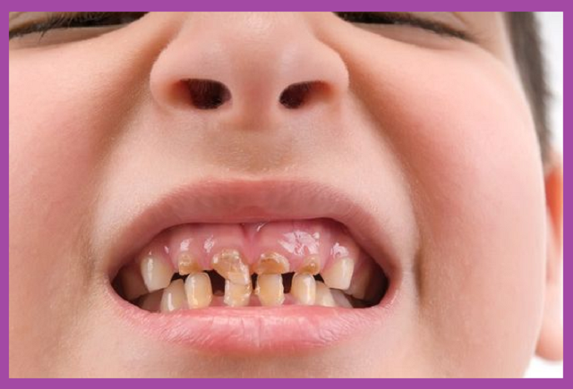 điều trị viêm tủy răng ở trẻ em