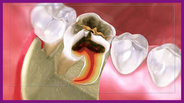 Đều trị viêm tủy răng tại nhà có nguy hiểm không
