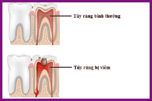 điều trị viêm tuỷ răng tphcm